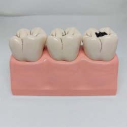 Stor Caries Studiemodel 